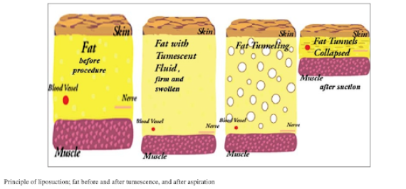 TUMESCENT LIPOSUCTION