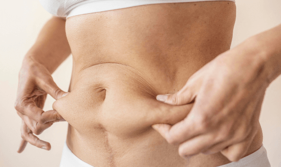 TUMESCENT LIPOSUCTION TUMESCENT LIPOSUCTION