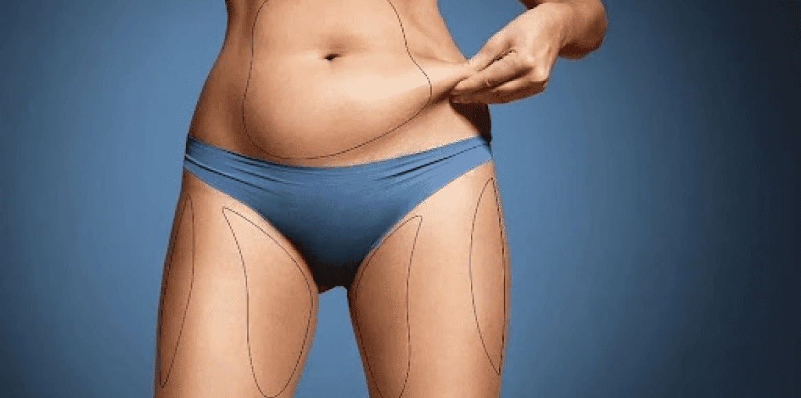 TUMESCENT LIPOSUCTION TUMESCENT LIPOSUCTION