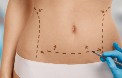 Liposuction vs. Non-Surgical Alternatives: Making the Right Choice