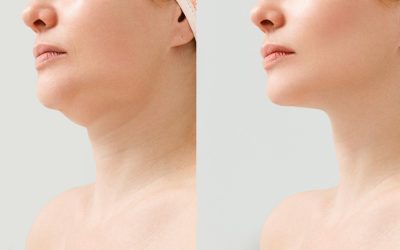 Double Chin: One Solution Get a More Defined and Youthful Jawline with Endolift
