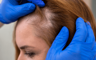 PRP Therapy for Hair Loss: Is It Worth the Investment?