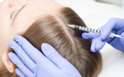 PRP for Hair Loss: How It Works and What to Expect