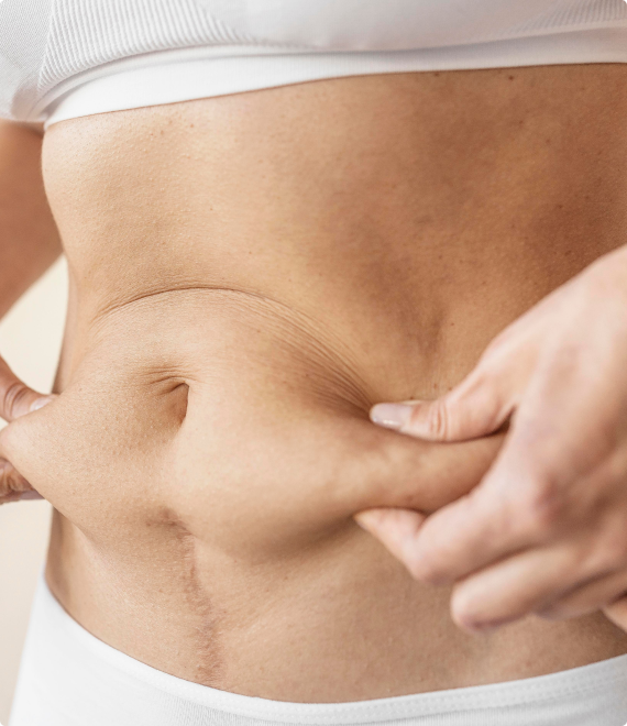 How is a Tumescent Liposuction Performed img