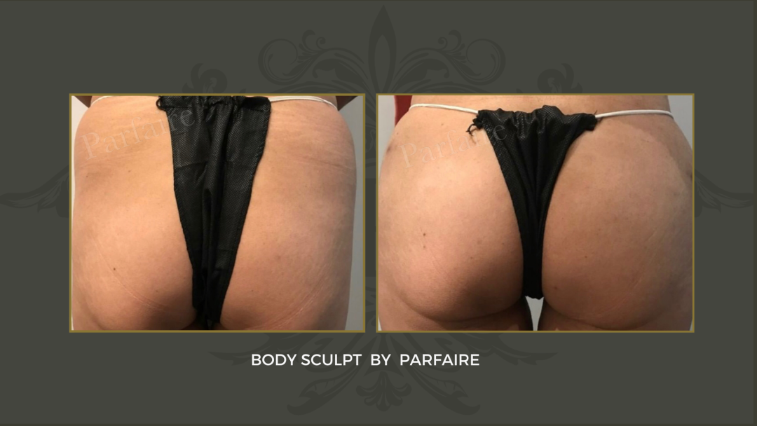 Body sculpt