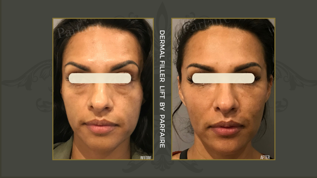 Filler Lift