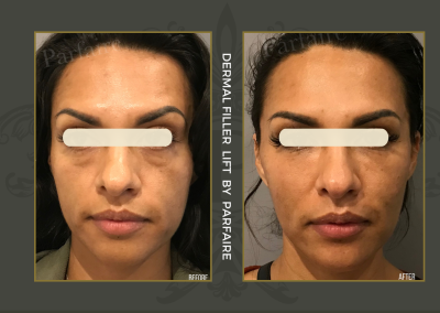 Filler Lift