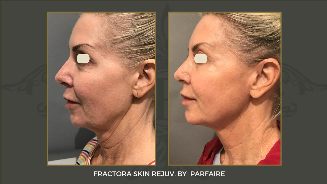 Fractora Skin Rejuv.