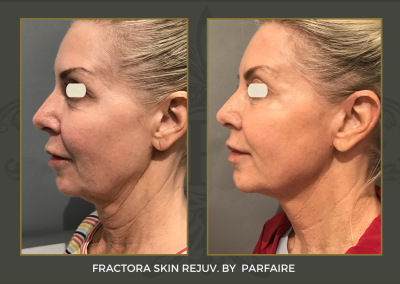 Fractora Skin Rejuv.