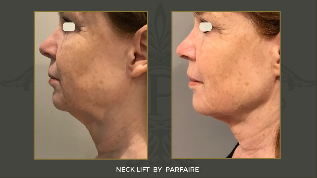 Neck lift 1