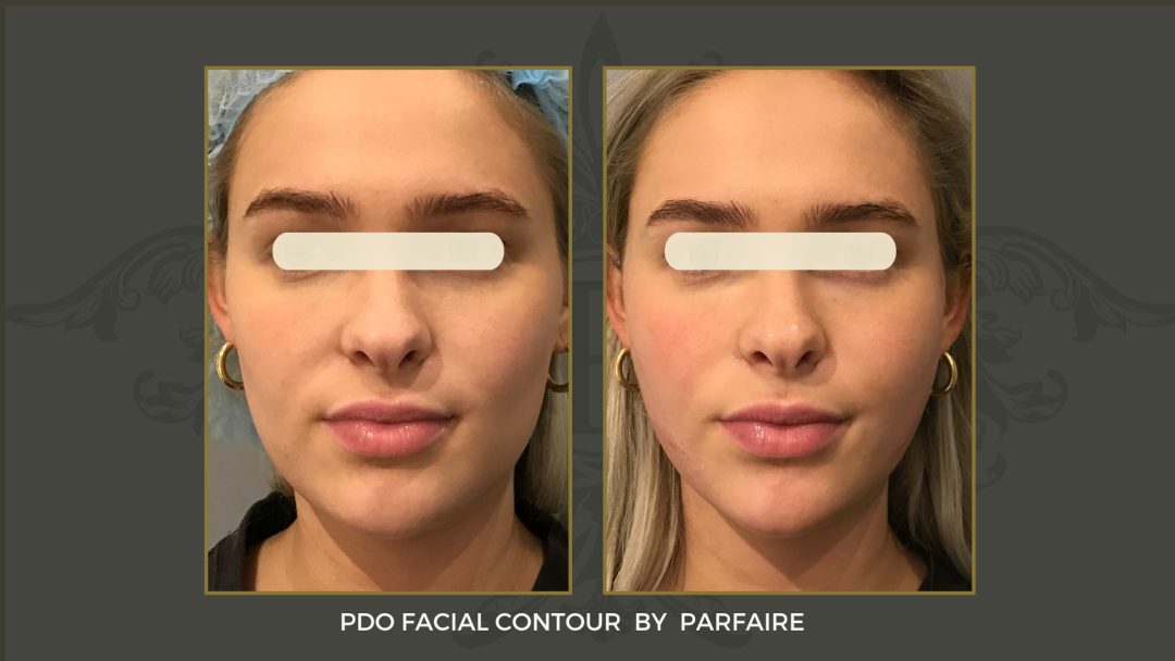 PDO facial Contour