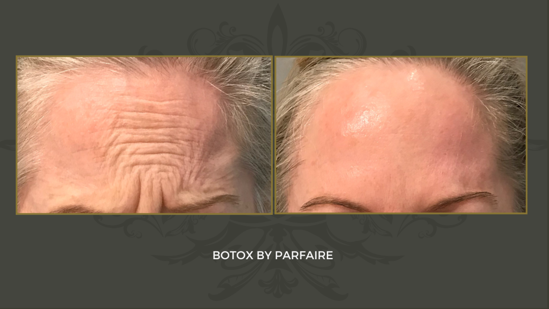 botox