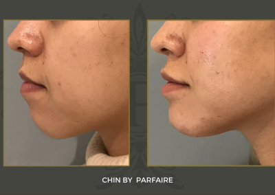 chin