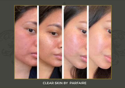clearskin 1