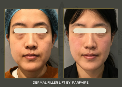 filler lift copy