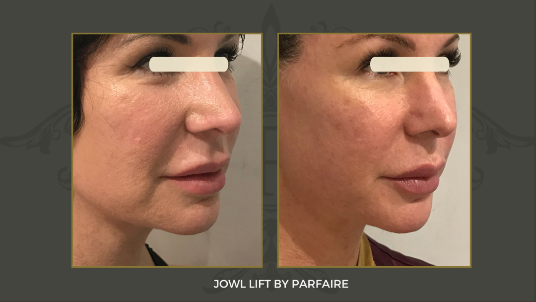 jowl lift