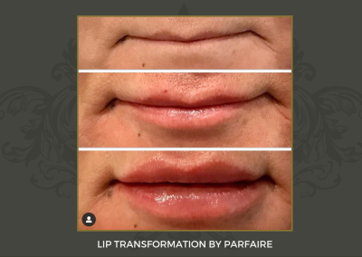 lip trans
