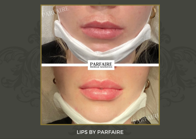 lips4