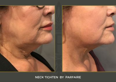neck tighten1