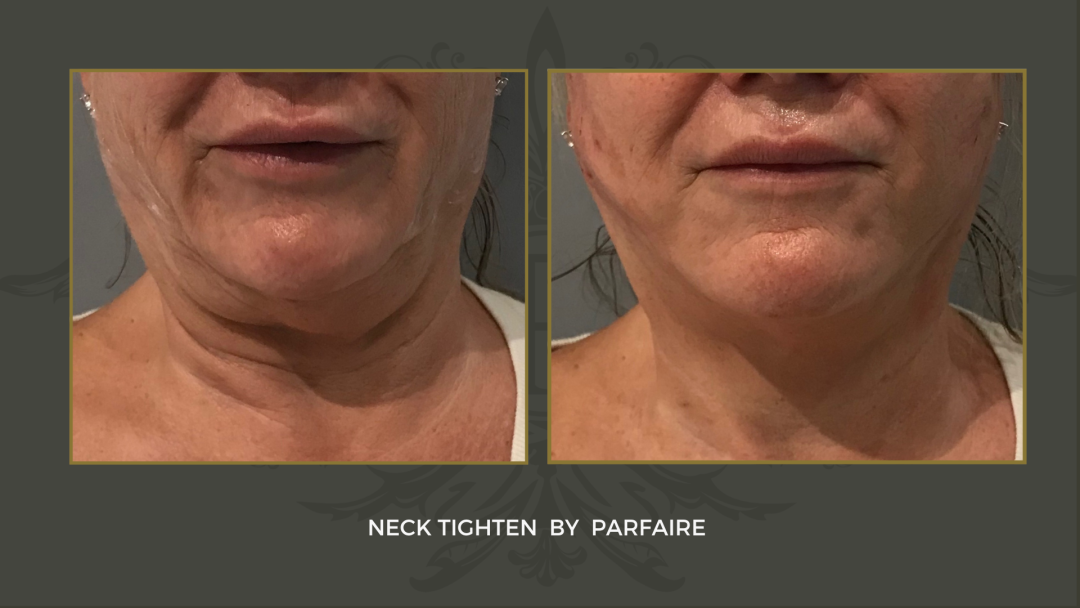 neck tighten2