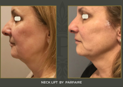 necklift2