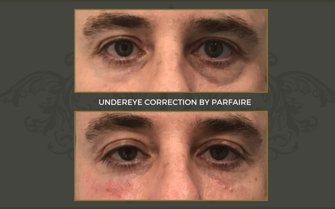 undereye