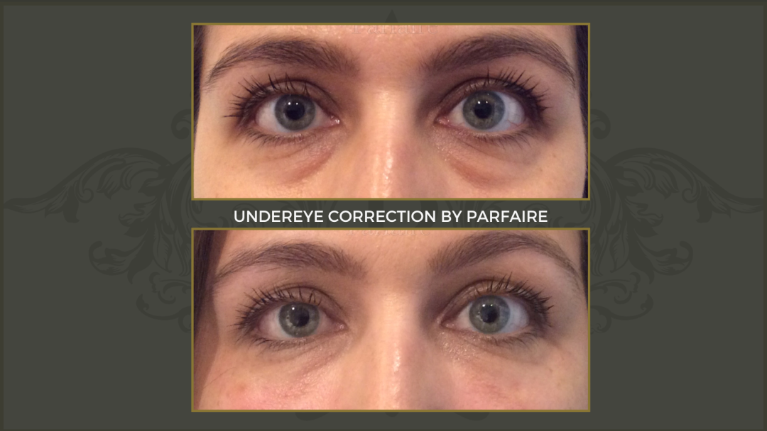 undereye (2)