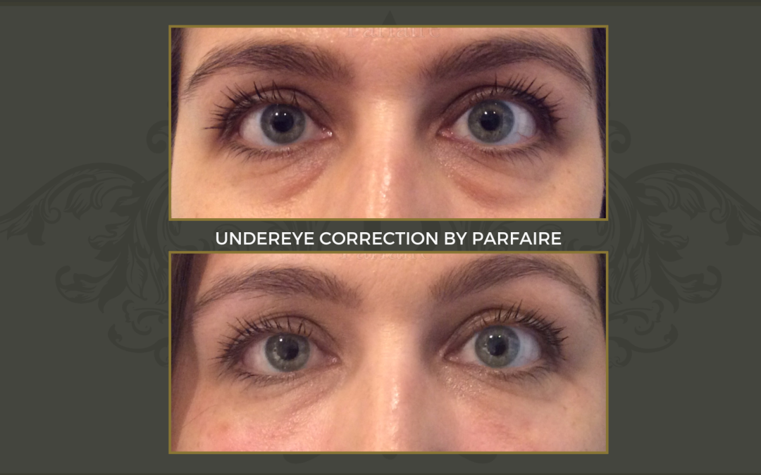 undereye (2)