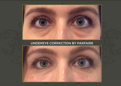 undereye (2)
