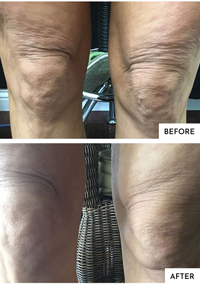 Before-After