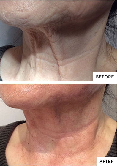 Before-After