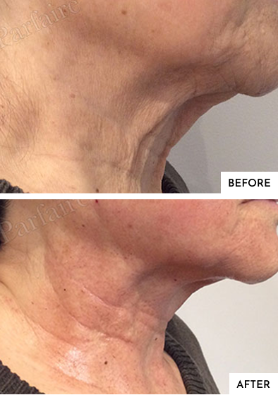 Before-After