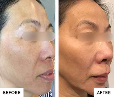 Before After