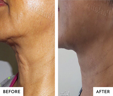 Before-After