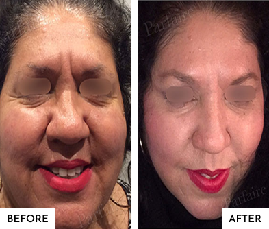 Before-After