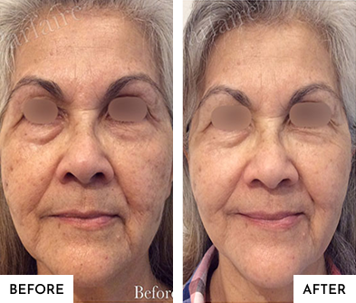 Before-After