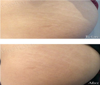 Before After